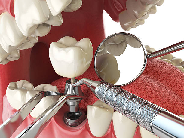 Best Dentist for Tooth Abscess  in North Canton, OH